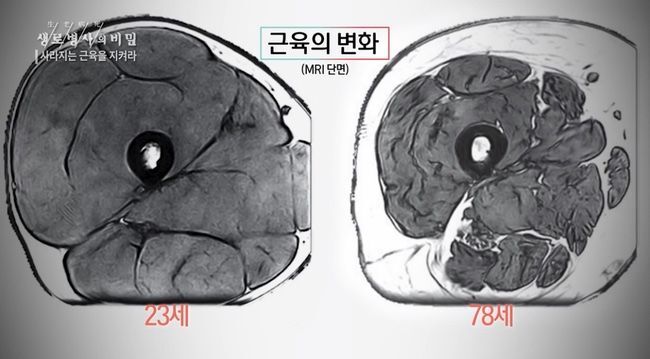 20대와 70대의 허벅지 단면 차이 - 꾸르